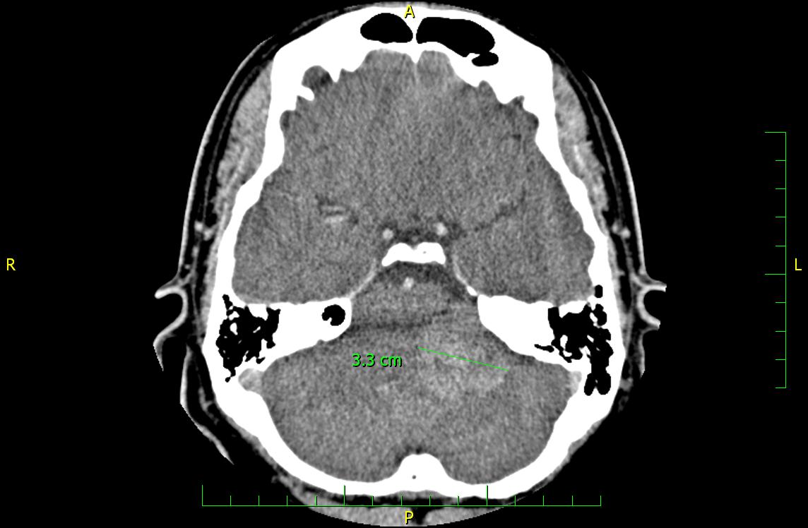 CT mozku 2008-05-06 vestibularni schwannom.JPG