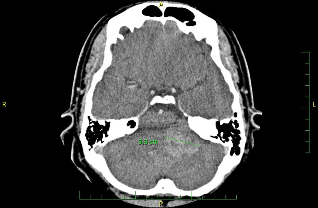 CT mozku 2008-05-06.JPG