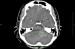 CT mozku 2008-05-06 vestibularni schwannom.JPG